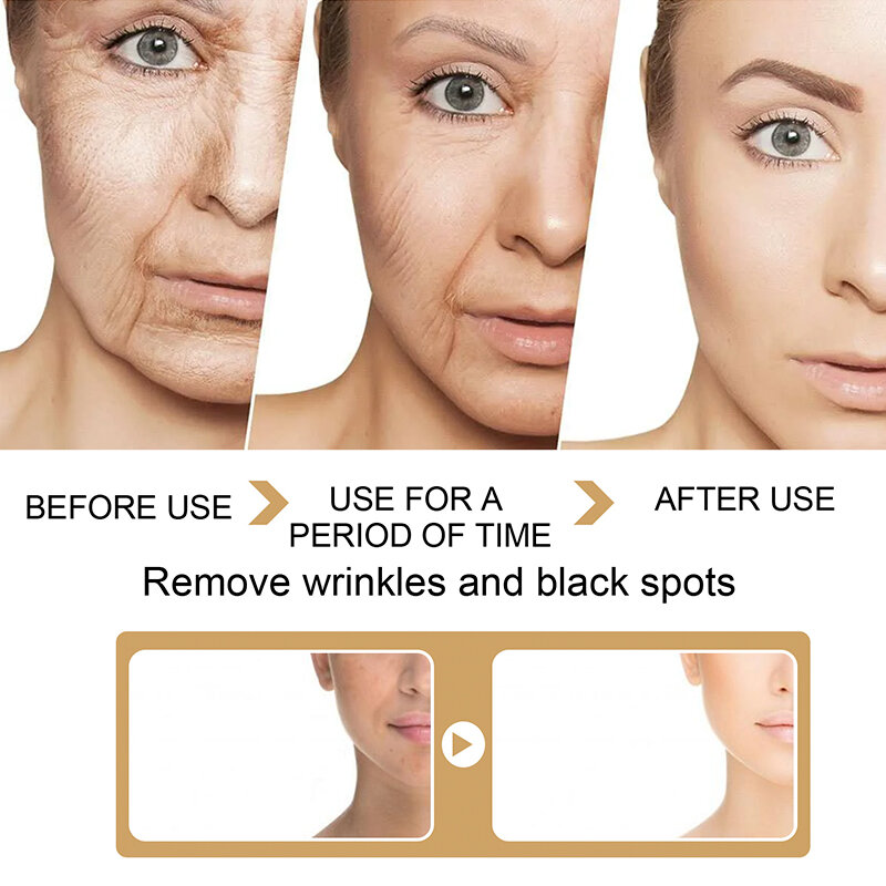 Aceite de cúrcuma para aclarar el acné, parches oscuros para el acné, Corrector de manchas oscuras, antienvejecimiento, suero blanqueador facial, cuidado de la piel, 30ml