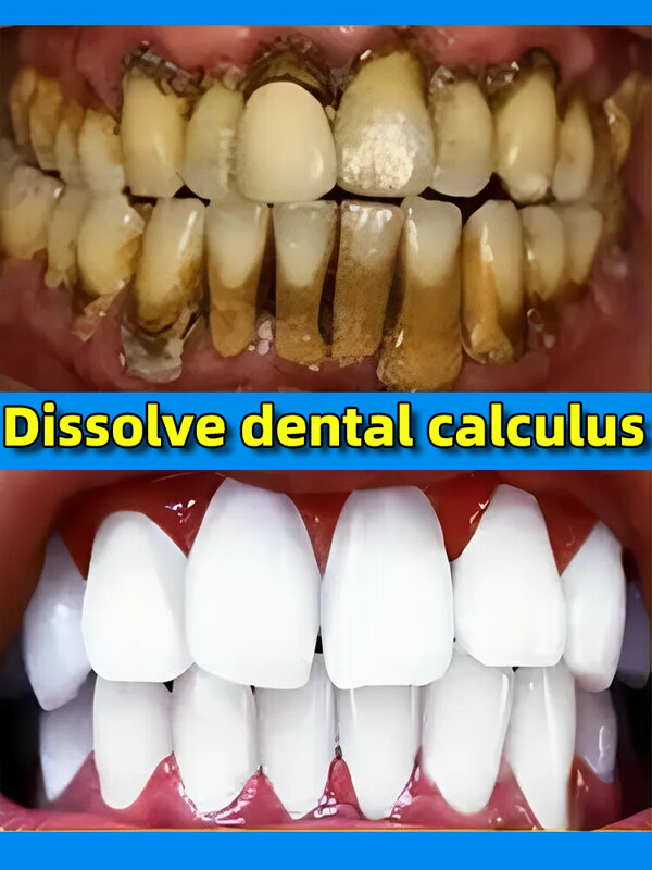 Fourni ver calcul dentaire filtré, élimination des odeurs de la bouche des dents, mauvaise prévention temporaire de la parodontite
