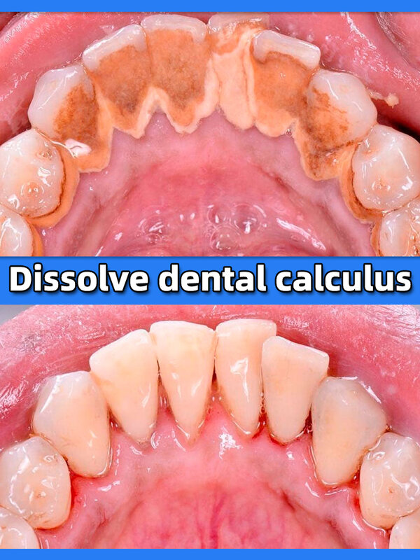 Verwijderaar Tandheelkundige Calculus Bleken Tanden Mondgeur Verwijderen Slechte Adem Voorkomen Parodontitis
