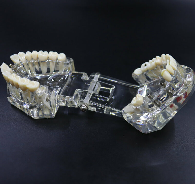 Modelo de dentário para implante, modelo de restauração dental, material de laboratório dentário ativo