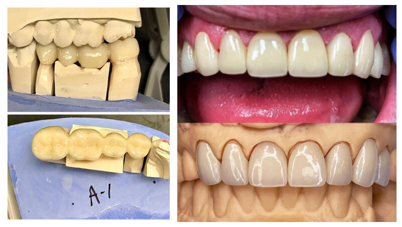 Bloques de circonita multicapa en blanco para equipo de laboratorio Dental CADCAM, sistema abierto STML, disco de circonita, colores A3.5 y A4, 3D