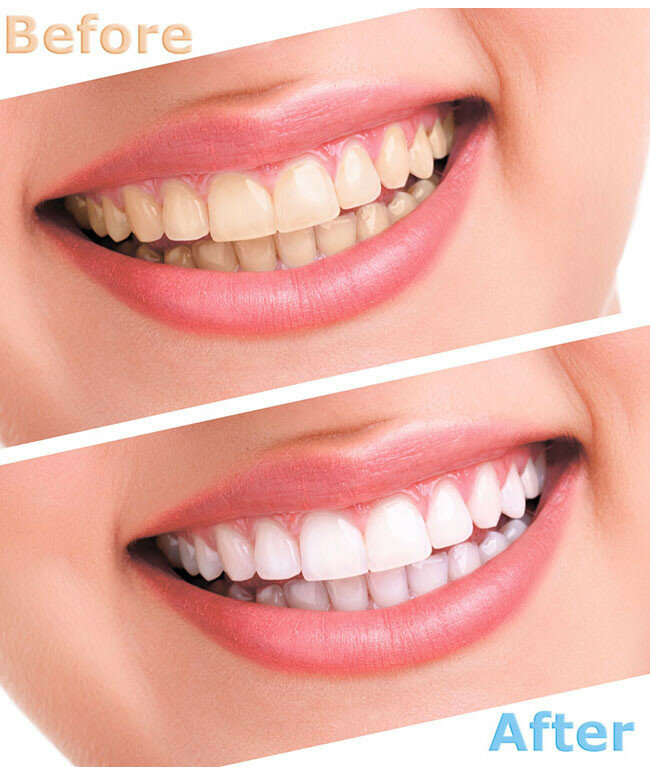 10 Buah Baru Pemutih Gigi Kit Gel Oral Pemutih Gigi Pena Gel Pemoles Gigi Peralatan Baru 44% Peroksida Pemutih Gigi