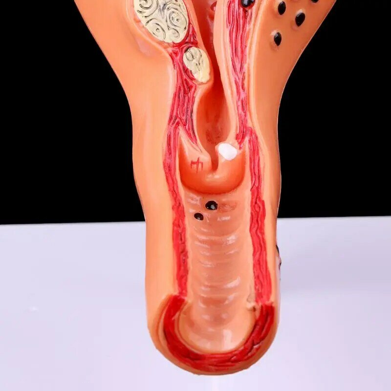 Accesorios médicos modelo gastos de envío gratis uterino patológico ovario modelo anatómico anatomía sección transversal herramienta de estudio