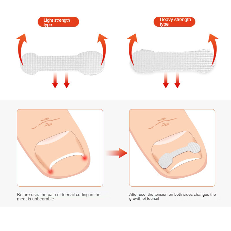 10pcs strumento di correzione dell'unghia del piede incarnito punta incarnita trattamento delle unghie adesivo Patch elastico raddrizzamento Clip Brace strumento Pedicure