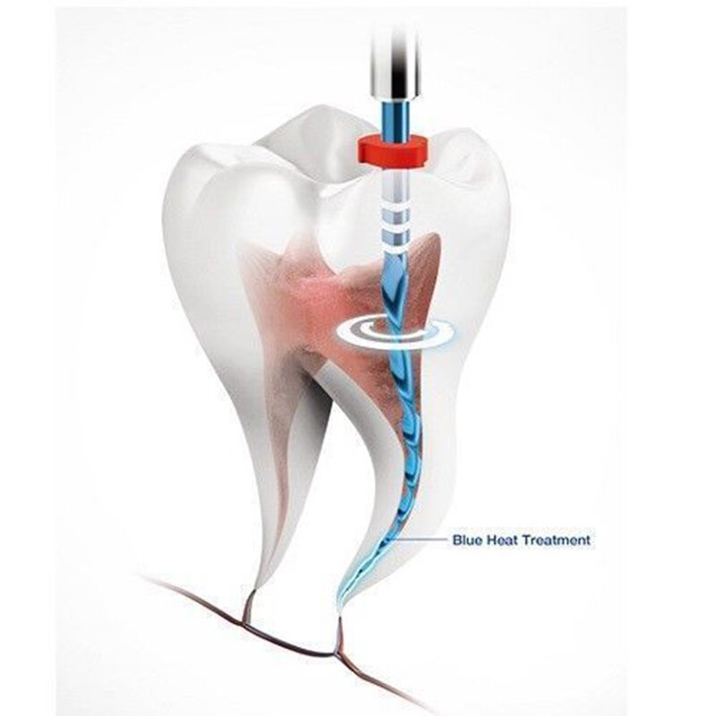 6 بلدان جزر المحيط الهادئ الأسنان ملف الأسنان الأزرق المعالجة الحرارية R50 21 مللي متر الطبية لأدوات معدات طبيب الأسنان إندو
