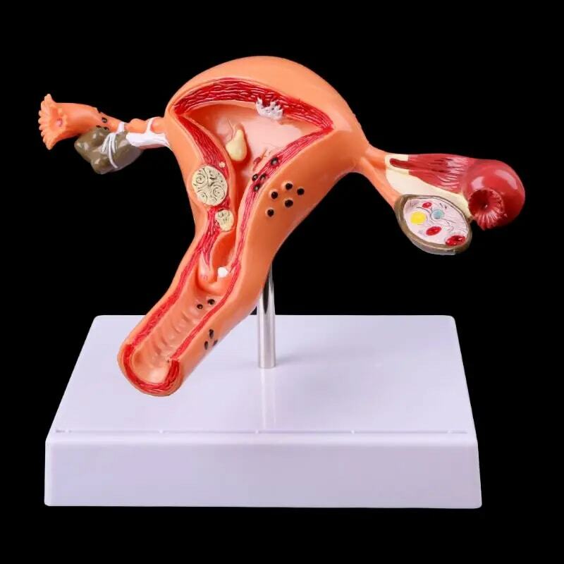 Modèle médical modèle gratuit affranchissement pathologique utérus ovaire modèle anatomique anatomie coupe transversale outil d'étude