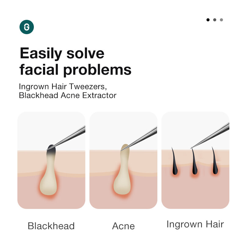MR.GREEN Ingrown Hair Tweezers Needle Nose Pointed Tips Eyebrows Tweezers For Splinters Blackhead Removal Acne Clip Extractor