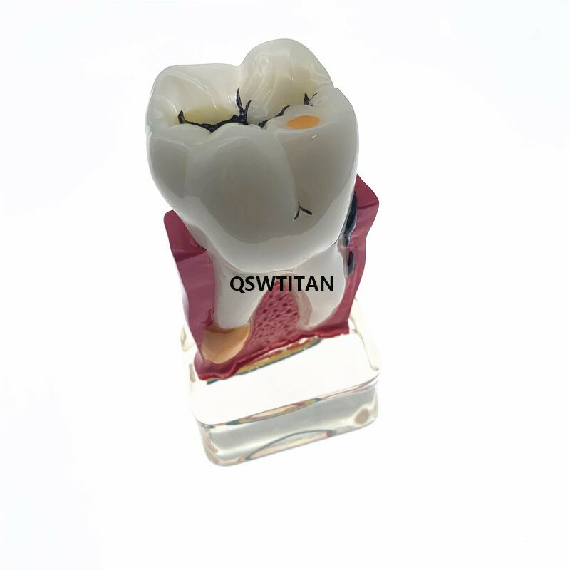 Estudo dental de dentista 4 vezes, modelo de patologia dos dentes, modelo de doença dos dentes, material dental para ensino