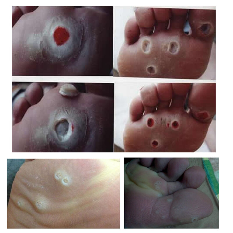 18 Peças de Foot Care Callus Foot Care Callus Toe Proteção Tape Mão e Pé Cocoon Plaster