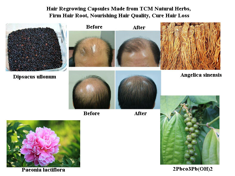 Hair Regrowing Formula Made from TCM Natural Herbs, Firm Hair Root, Nourishing Hair Quality, Cure Hair Loss, Germinal