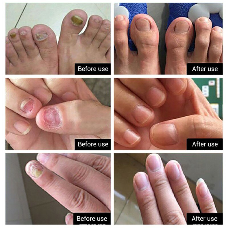 Nail Treatment Powerful Removal Fungus Repair Serum Feet Care Essence Anti Infection Paronychia Onychomycosis Fungal