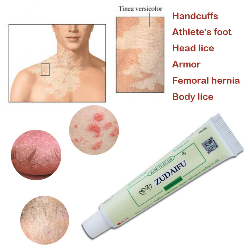 Dropshipping zudaifu pele psoríase creme dermatite eczematoid eczema pomada tratamento psoríase creme yiganerjing