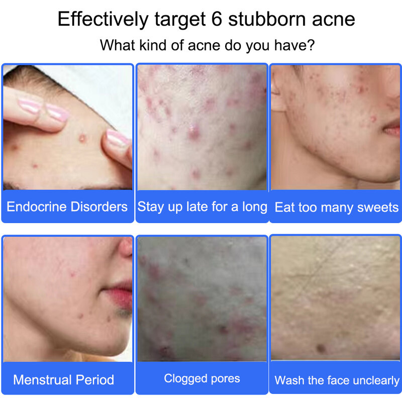 Crème de traitement de l'acné, dissolvant de points noirs pour cicatrices, Gel de réparation, contrôle du sébum, rétrécissement des Pores, blanchiment de la peau, cosmétiques coréens