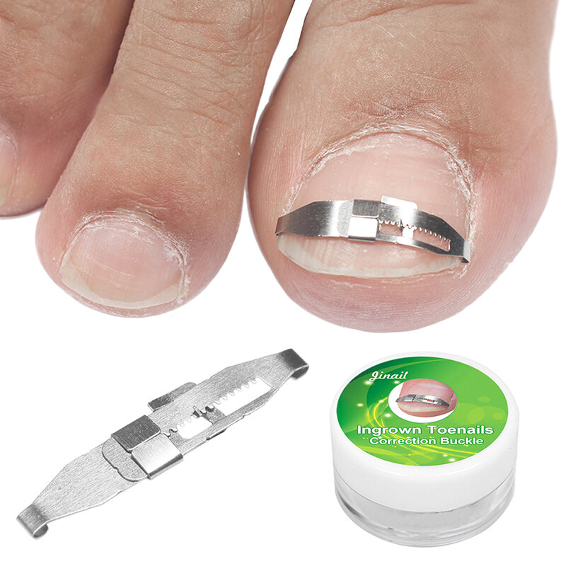 Ingrown Toe Nail Correction Wire Fixer Pedicure Paronychia Recover Toenails Corrector Foot Care Tool High Quality