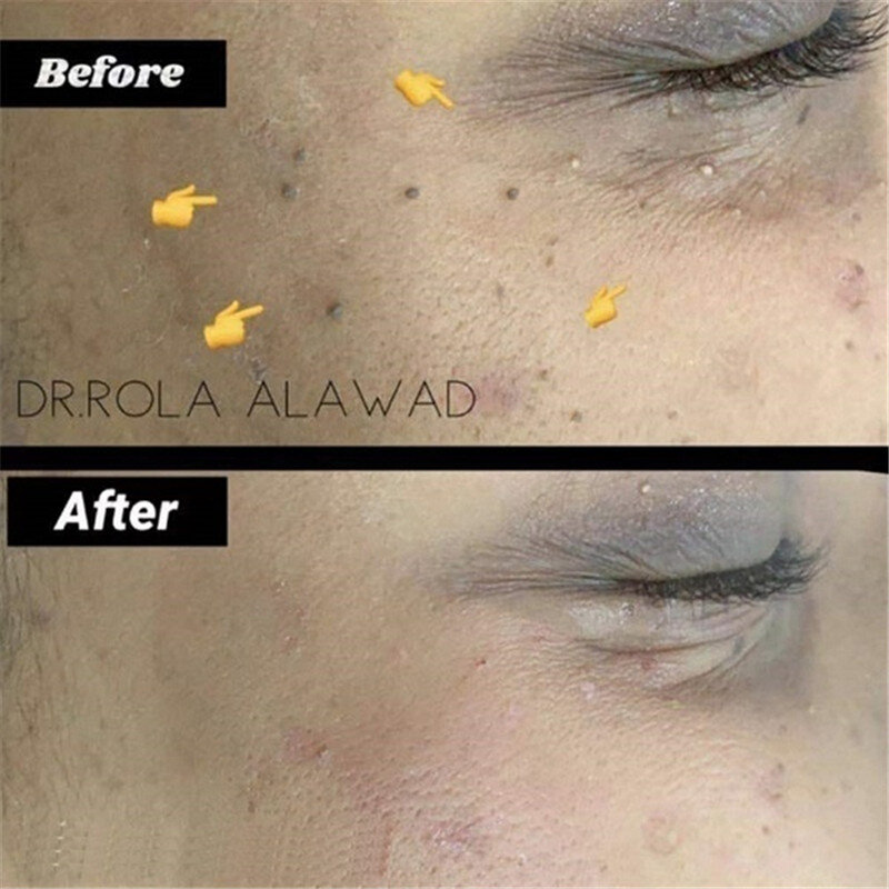 Tratamiento de verrugas genitales papilomas eliminación de verrugas líquido de etiquetas de piel removedor de moho Anti Verruca remedio 6ml