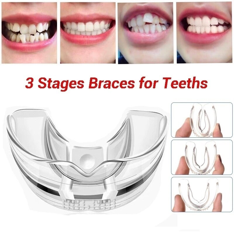 3 fasi ortodonzia dentale apparecchio apparecchio bretelle allineamento Trainer denti fermo smanismo bocca guardia denti raddrizzatore