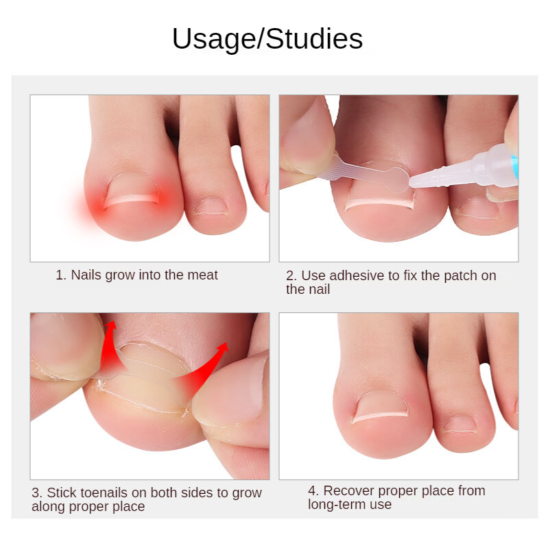 10 sztuk wrastające paznokieć narzędzie do korekcji wrastające Toe terapia na paznokcie elastyczna naszywka klip do prostowania Brace narzędzie do Pedicure