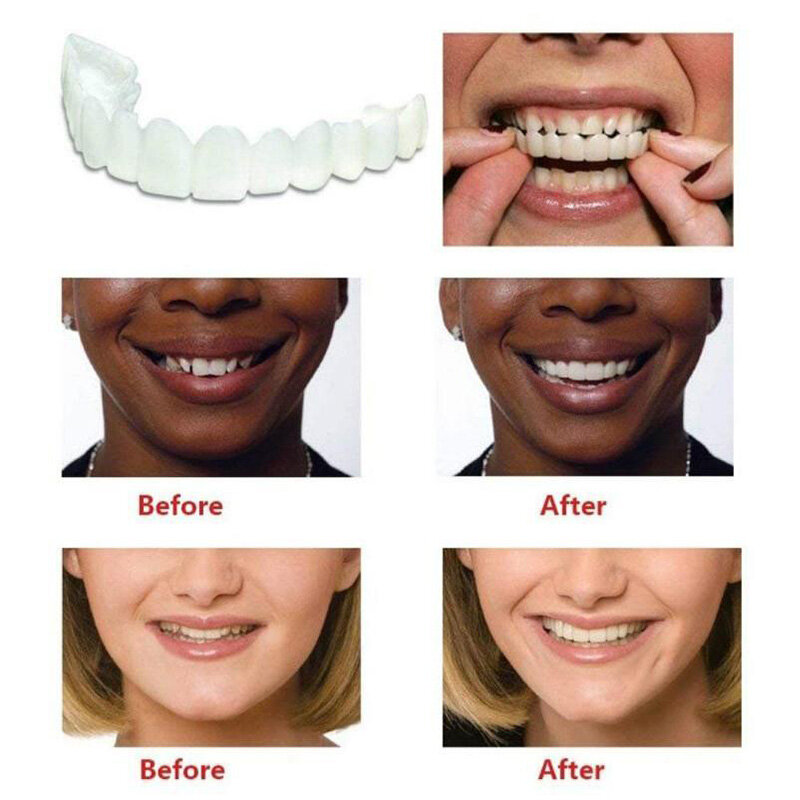 Impiallacciature per denti superiori e inferiori bretelle anti-vero Snap On Smile denti sbiancamento denti per protesi denti per impiallacciatura comodi