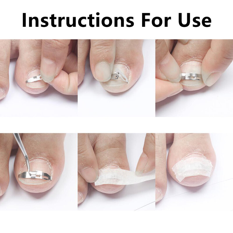 Ingrown Toe Nail Correction Tool Toenail Straightening Correctors Patch Tool Straightening Clip Brace Pedicure Tool