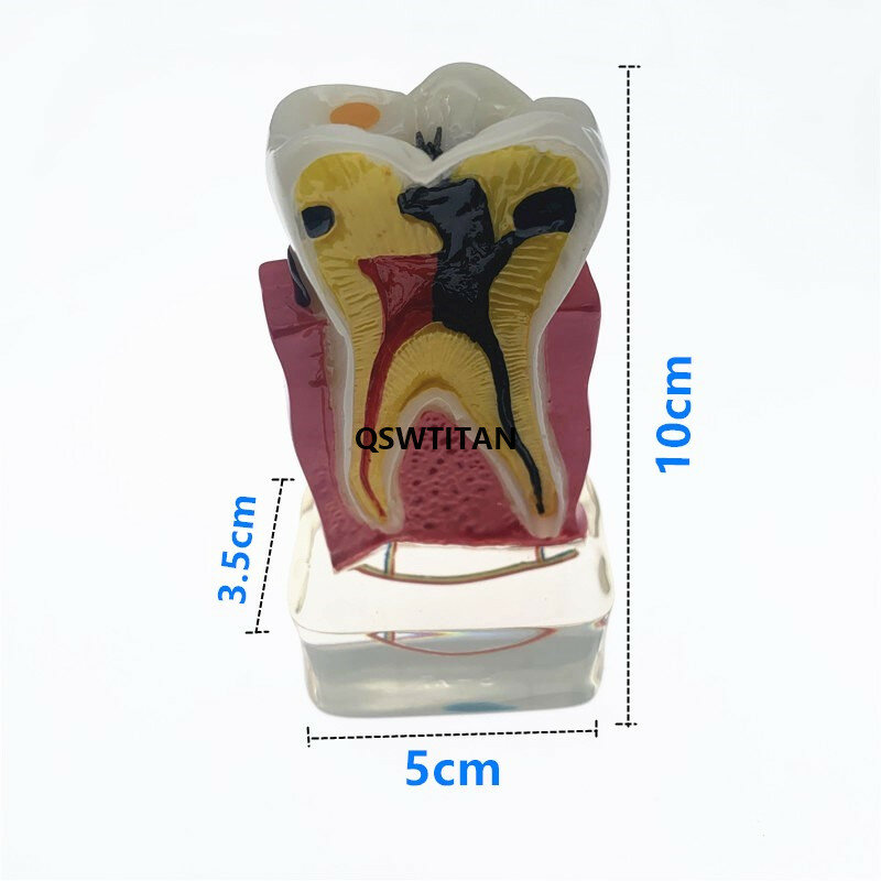 Dentista studio dentale 4 volte modello di malattia del dente modello modello di malattia dei denti materiale dentale insegnamento