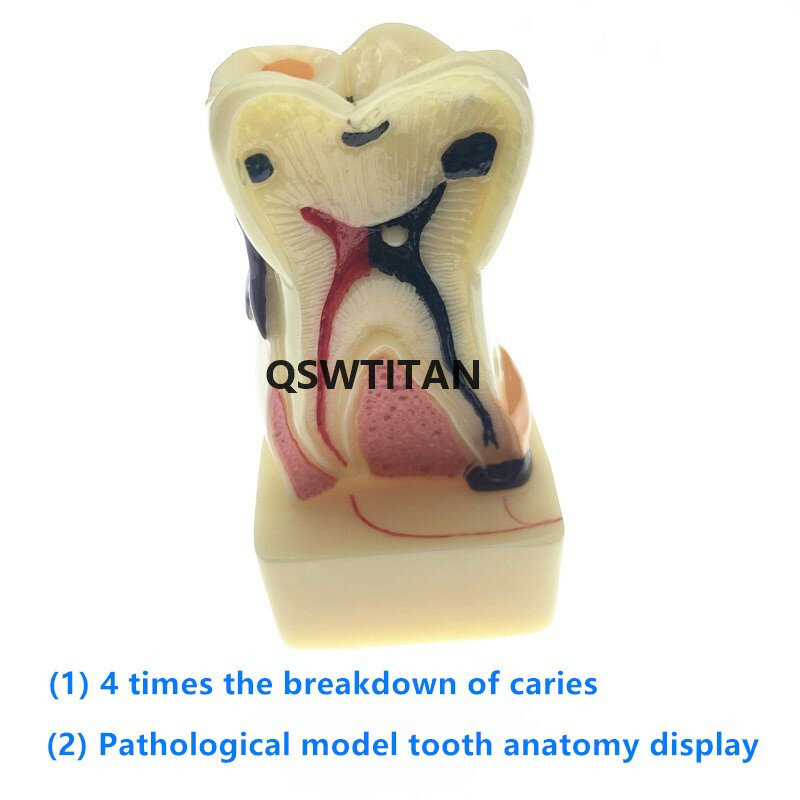 Dentiste étude dentaire 4 fois, modèle de pathologie dentaire, modèle de maladie dentaire, fournitures dentaires d'enseignement