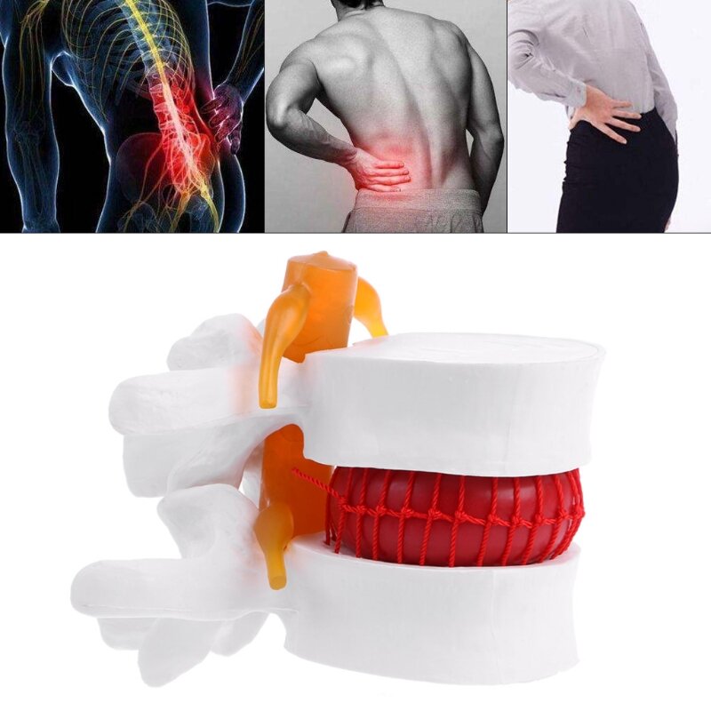Modelo de hernia de disco Lumbar anatómico humano, ayuda para el aprendizaje médico, instrumento de anatomía D5QC