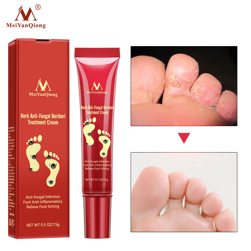 Tratamiento de uñas a base de hierbas Anti hongos alivio Pie de Beriberi crema cuidado de la piel dedo del pie tratamiento Anti infección micótica Reparación de pies