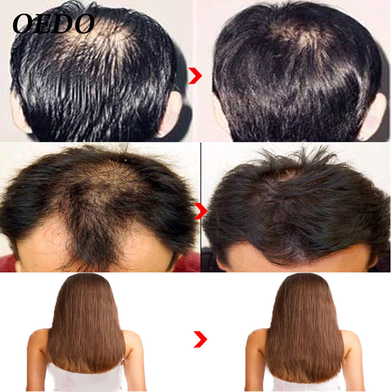 OEDO Marruecos de Ginseng de cuidado del cabello Esencia de tratamiento para hombres y mujeres, la pérdida de cabello rápido poderoso el crecimiento del cabello suero de reparación raíz
