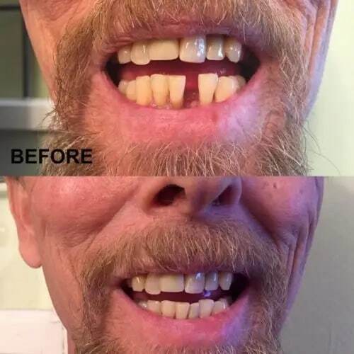 Carillas dentales para dientes postizos, carillas de sonrisa extraíbles en los dientes, Kit de fijación temporal de dientes, Color Natural