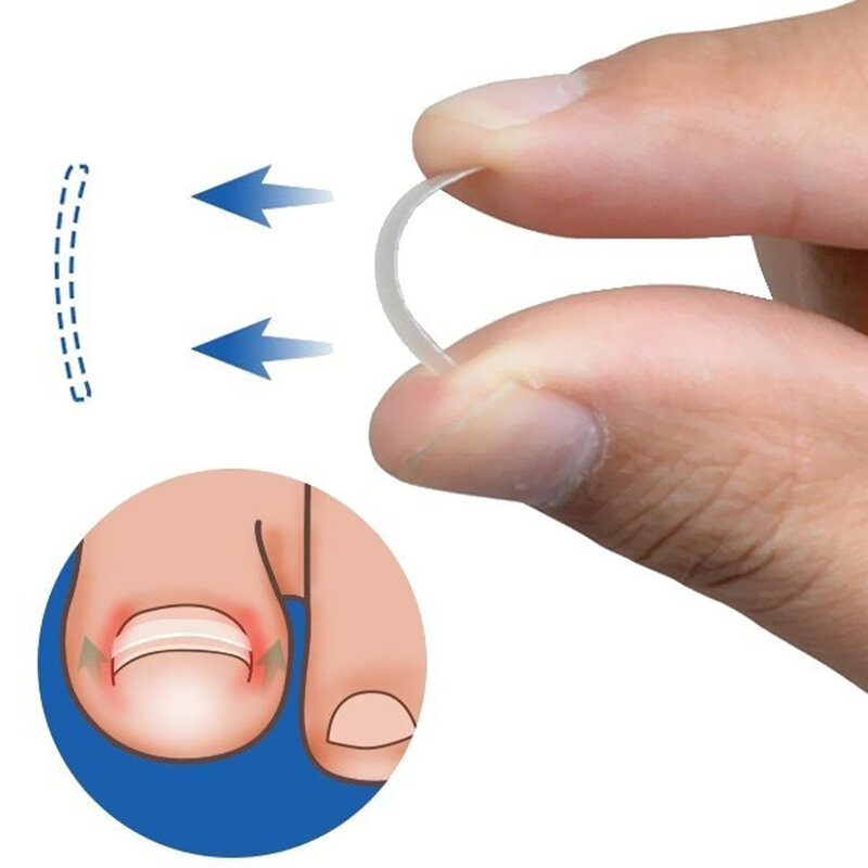 Gorące wrastające narzędzie do korekcji paznokci wrastające palce terapia na paznokcie elastyczna naszywka klip do prostowania Brace narzędzie do Pedicure