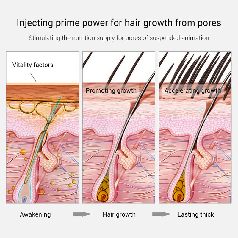 LANBENA от выпадения волос спрей быстро средства для роста волос предотвращают выпадение консолидации питают корни волос лечебная сыворотка