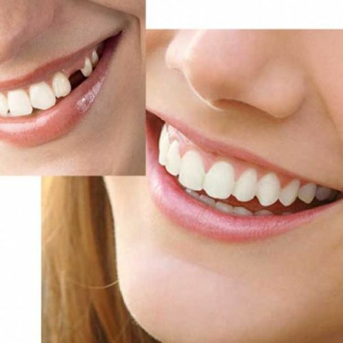 Carillas dentales para dientes postizos, carillas de sonrisa extraíbles en los dientes, Kit de fijación temporal de dientes, Color Natural
