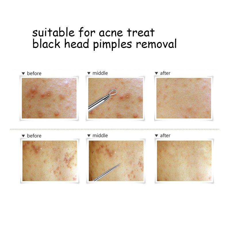 Black DotสิวBlackhead Removerเข็มเครื่องมือสำหรับบีบสิวเครื่องมือช้อนสำหรับทำความสะอาดใบหน้าComedone EXTRACTOR Pore CLEANER