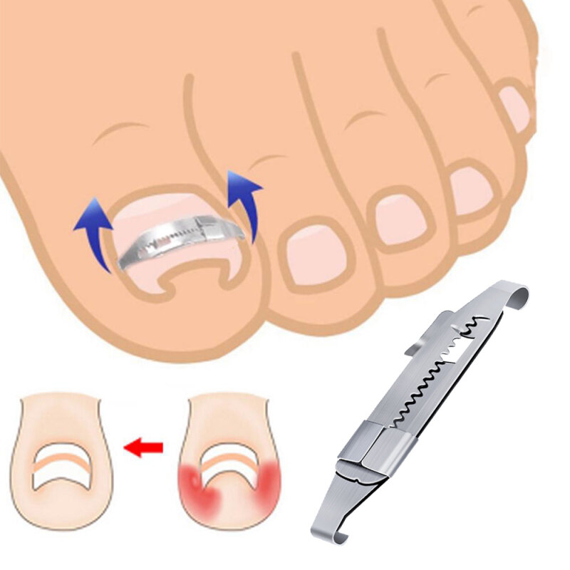 Herramienta de corrección de uñas encarnadas, parche corrector de alisado de uñas de los pies, Clip de alisado, Brace, herramienta de pedicura