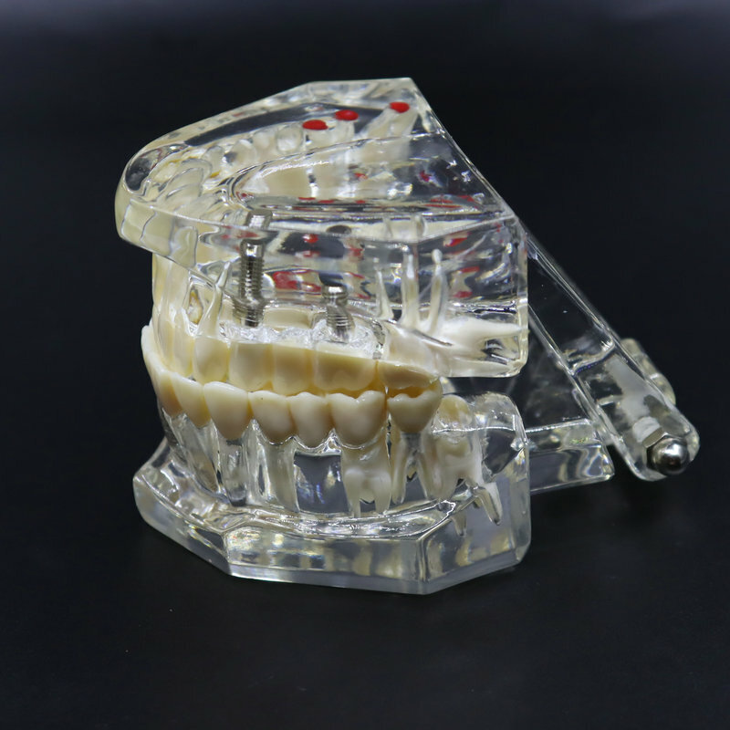 Modelo de dentário para implante, modelo de restauração dental, material de laboratório dentário ativo