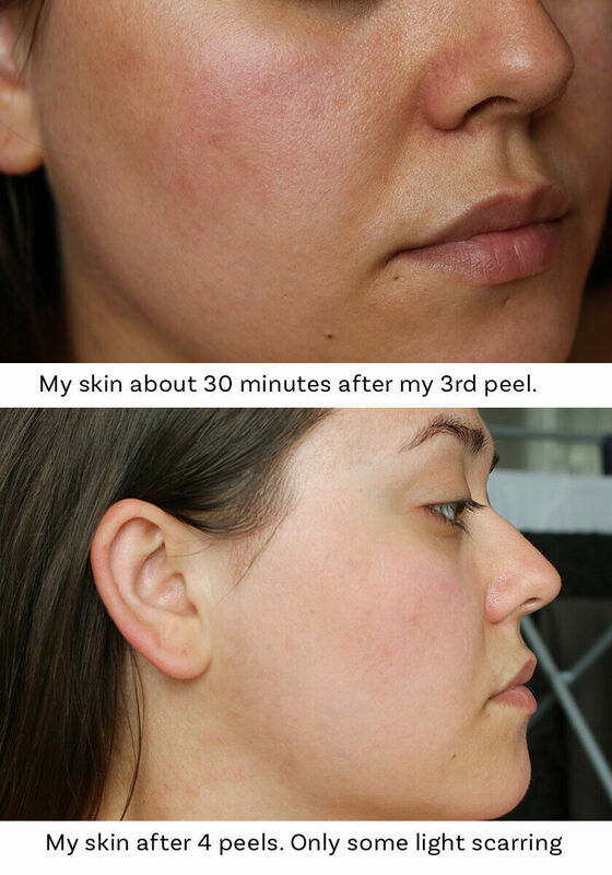 Glycolic Acid Peel 10% Aha Bha Skin Peel Acid Chemical Peel Freckle Peeling Treatment Age Defying, Erase Wrinkles, Large Pore