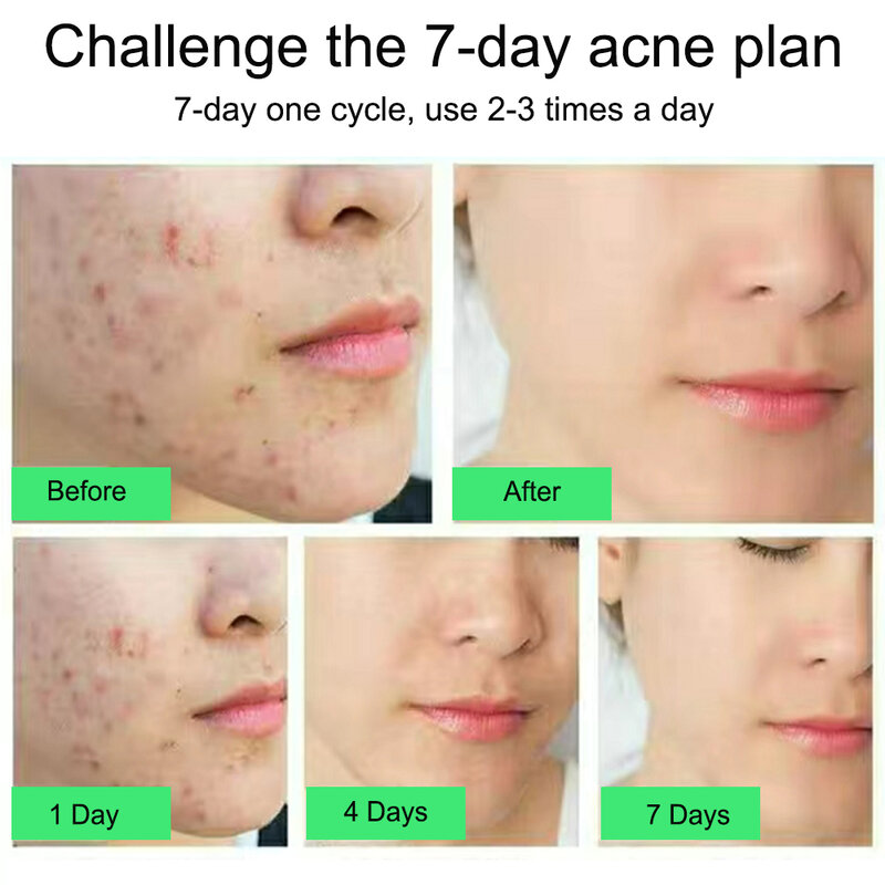 Crema facial para el tratamiento del acné, Gel reparador para eliminar puntos negros, Control de aceite, reduce los poros, blanqueamiento, cuidado de la piel, Cosméticos Coreanos