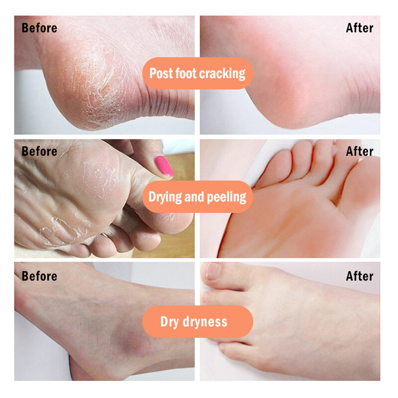 Removedor Natural de piel muerta, crema para pies con grietas antisecado, reparación de talón, crema agrietada, cuidado de manos y pies, TSLM2
