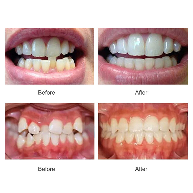 Retenue de dents en silicone instantanée, bretelles orthodontiques, protège-dents, entraîneur dentaire, 11% ment, dents en polaire