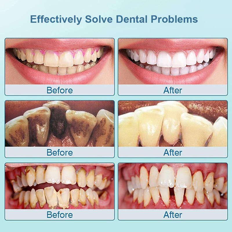 Raspador Dental Ultra sónico para dientes, removedor de cálculo Dental Para manchas de sarro, limpiador eléctrico de placa Dental, eliminación de piedras dentales