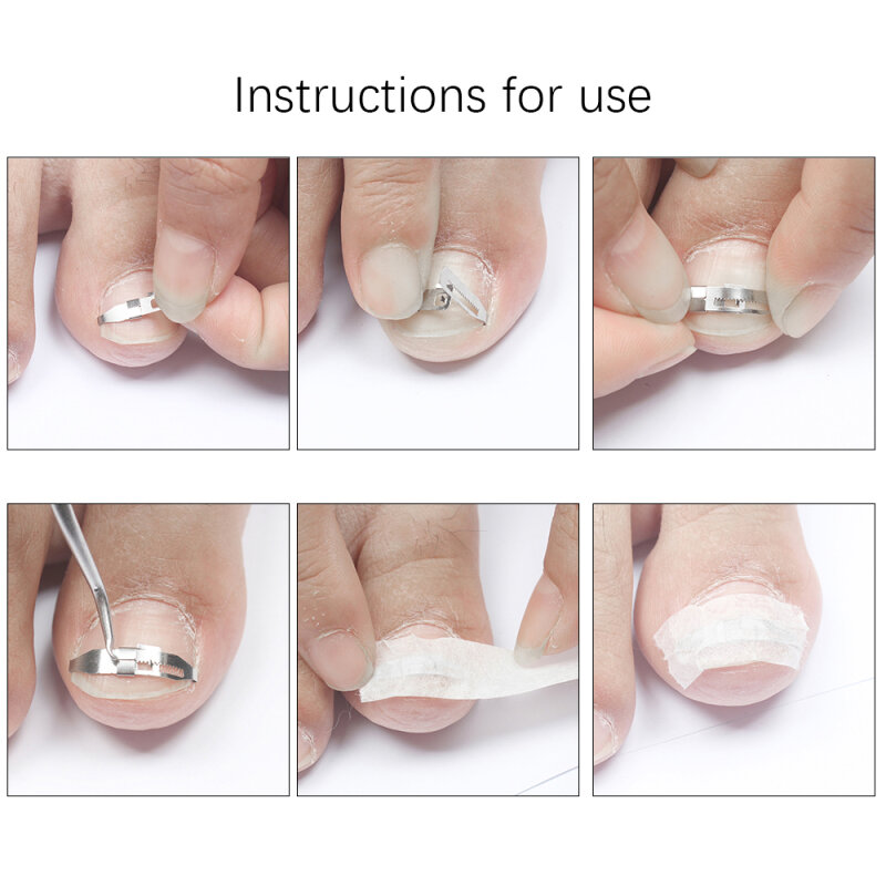 Ingrown Toe Nail Correction Tool Toenail Straightening Correctors Patch Tool Kit Nail Repairer Orthosis Beauty Tools