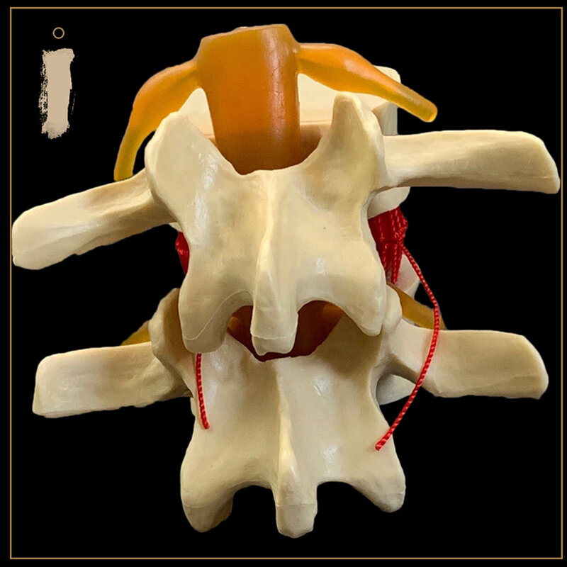 Vertebre lombari umane anatomiche modello dimostrativo di ernia del disco lombare-bianco, giallo