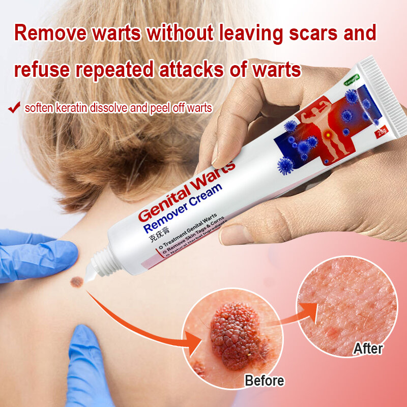 3 Types Warts Remover Antibacterial Ointment Private Parts Wart Treatment Cream Skin Tag Remover Human Papilloma Virus Ointment