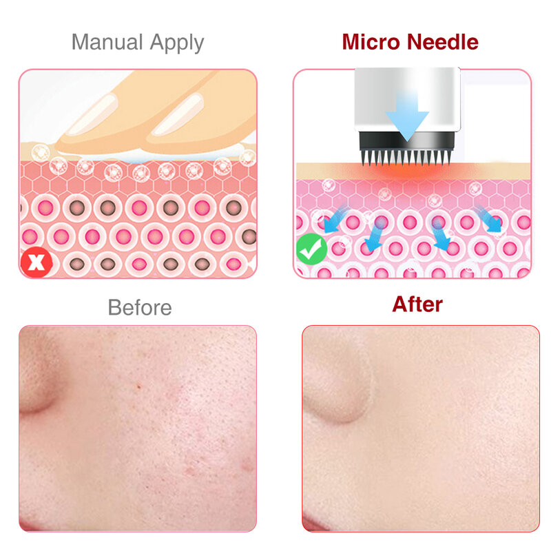 Electric Micro Needle Micro Pen Cartridge Needle Tip Exfoliate Shrink Pores Device Electric Micro Rolling Stamp Therapy Skincare