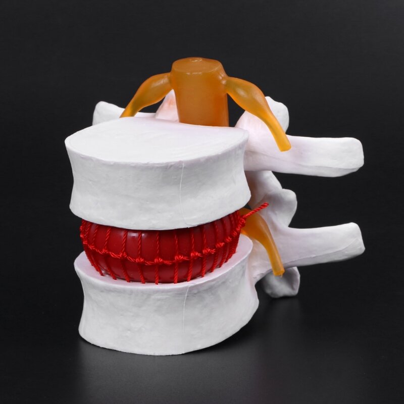 Modelo de hernia de disco Lumbar anatómico humano, ayuda para el aprendizaje médico, instrumento de anatomía D5QC