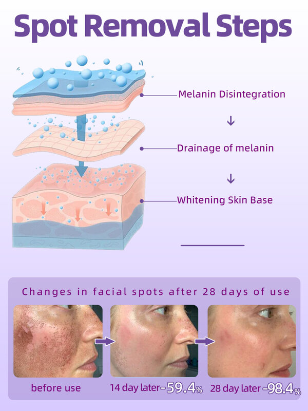 Sommersprossen entfernen Melasma Creme dunklen Fleckent ferner für das Gesicht