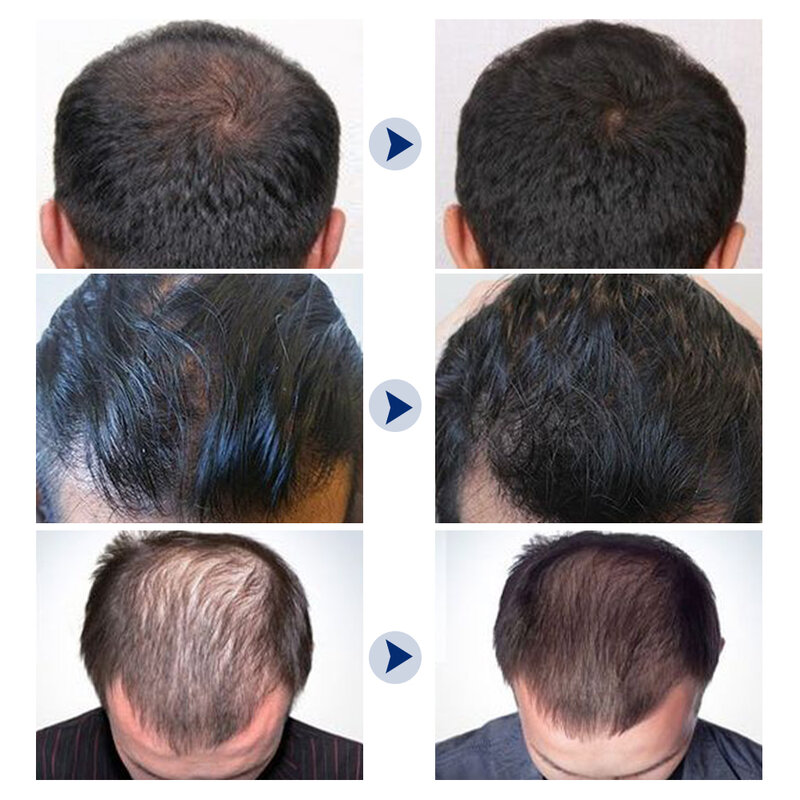 Aceite esencial para el crecimiento del cabello, pulverizador anticaída, tratamiento para el crecimiento de la barba, reparación de daños en las raíces del cabello, producto para el cuidado del cabello