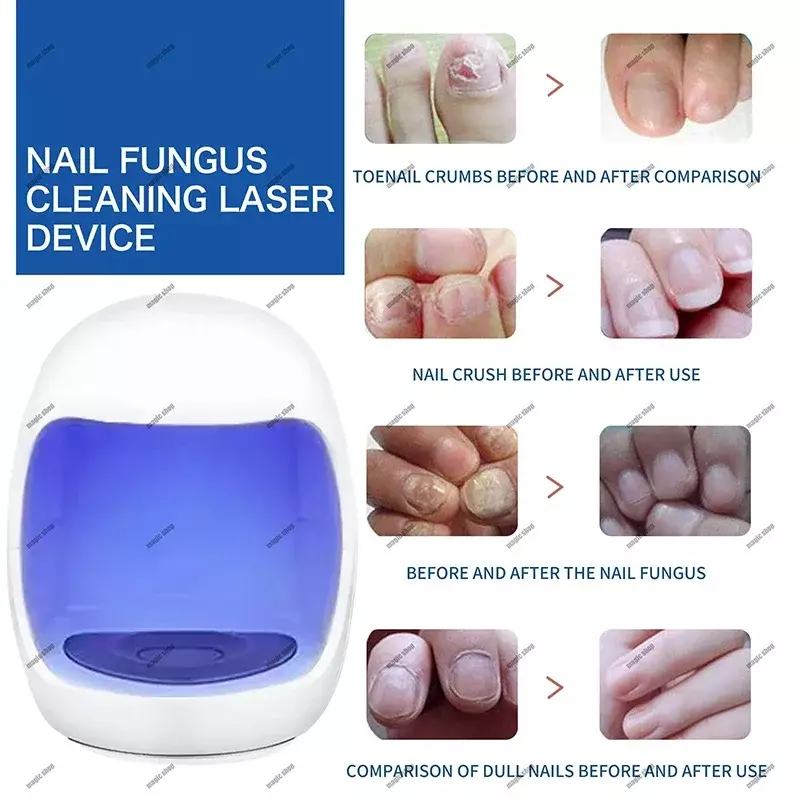 真菌ネイルレーザーデバイス、迅速な釘、爪真菌症