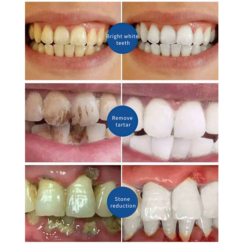 Neue Reparatur von Hohlräumen Karies Entfernung von Plaque Flecken Zerfall Bleaching Vergilbung Reparatur Zähne Zahn aufhellung Zahnpasta 120g