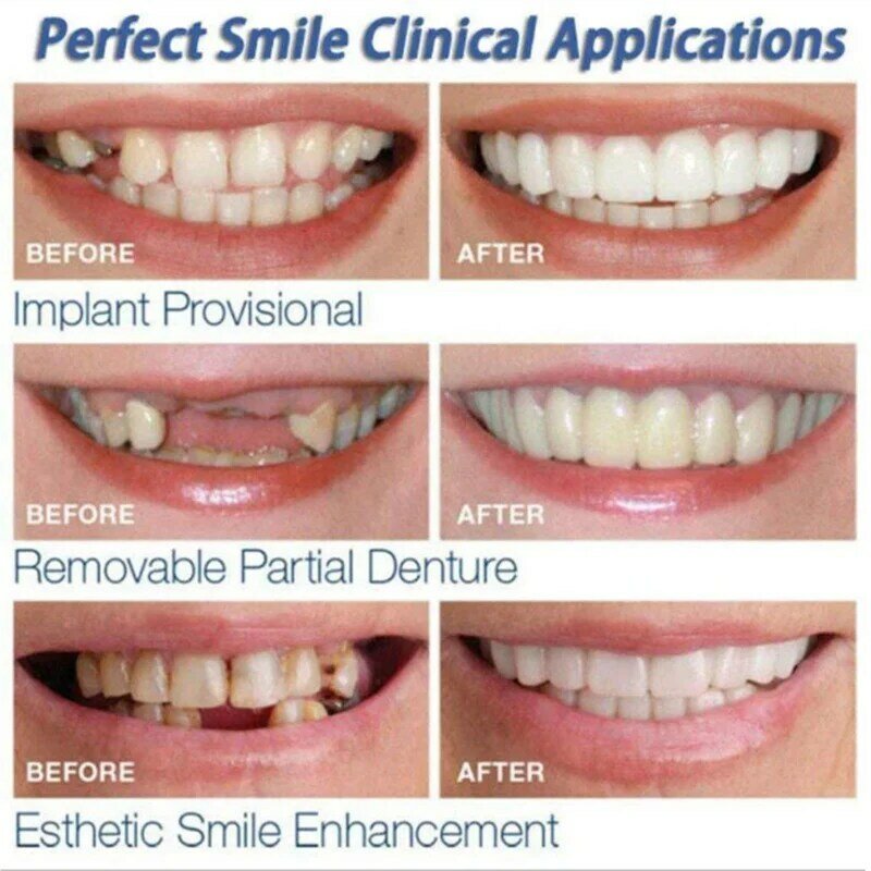Upper & Lower ฟันวีเนียร์ Anti-True วงเล็บ Snap On Smile Teeth Whitening ฟันปลอมฟันปลอมสบายวีเนียร์ฝาครอบฟัน
